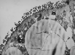 celiakia … reduced microvilli, lipid droplets celiakia … reduced microvilli, lipid droplets